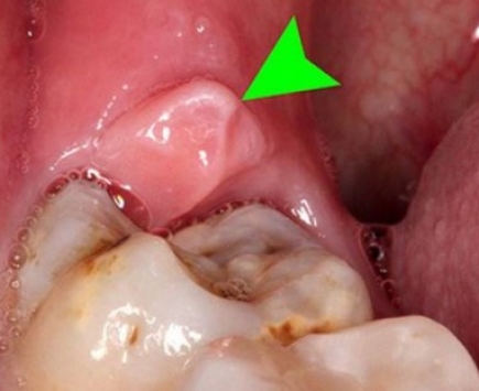 Tiểu phẫu răng khôn là gì?