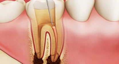 Điều trị tủy răng là gì