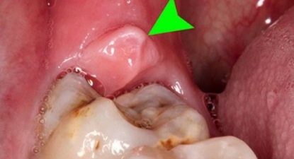 Tiểu phẫu răng khôn là gì?
