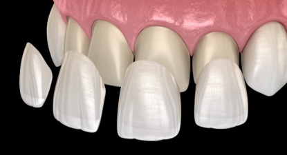 Mặt dán răng sứ Veneer là gì?