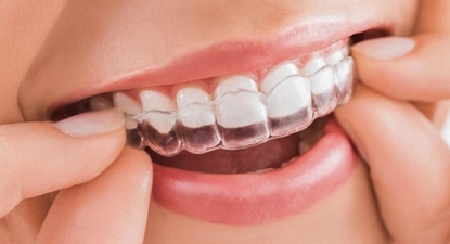 Niềng răng Invisalign là gì?