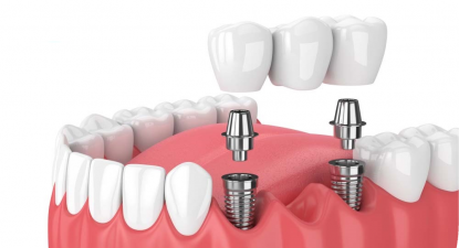 Địa chỉ trồng răng Implant uy tín tại TPHCM