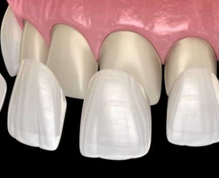 Mặt dán răng sứ Veneer là gì?